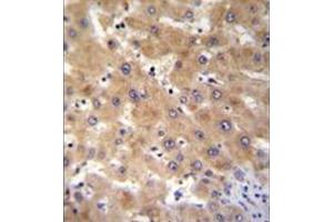 Immunohistochemistry analysis in formalin fixed and paraffin embedded human liver tissue reacted with GAGE12B Antibody (N-term) followed by peroxidase conjugation of the secondary antibody and DAB staining. (G Antigen 12B anticorps  (N-Term))
