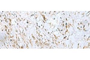 Immunohistochemistry of paraffin-embedded Human gastric cancer tissue using ECT2 Polyclonal Antibody at dilution of 1:35(x200) (ECT2 anticorps)