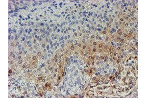 Immunohistochemical staining of paraffin-embedded Carcinoma of Human bladder tissue using anti-C17orf37 mouse monoclonal antibody. (C17orf37 anticorps)
