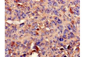 Immunohistochemistry of paraffin-embedded human melanoma using ABIN7169242 at dilution of 1:100
