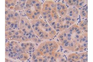 Detection of DNASE1 in Human Liver cancer Tissue using Polyclonal Antibody to Deoxyribonuclease I (DNASE1)