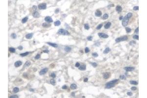 Detection of FUM in Human Glioma Tissue using Polyclonal Antibody to Fumarase (FUM)