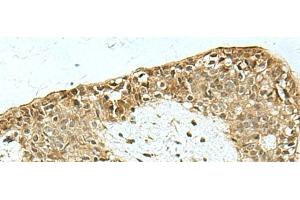 Immunohistochemistry of paraffin-embedded Human breast cancer tissue using KAT7 Polyclonal Antibody at dilution of 1:55(x200) (MYST2 anticorps)