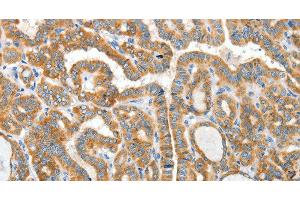 Immunohistochemistry of paraffin-embedded Human thyroid cancer using CKAP4 Polyclonal Antibody at dilution of 1:50 (CKAP4 anticorps)