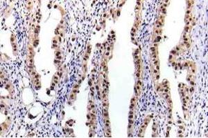 Immunohistochemistry (IHC) analyzes of p-STAT-5A antibody in paraffin-embedded human lung carcinoma tissue. (STAT5A anticorps  (pSer780))