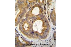TRPM8 Antibody (N-term) immunohistochemistry analysis in formalin fixed and paraffin embedded human prostate carcinoma followed by peroxidase conjugation of the secondary antibody and DAB staining. (TRPM8 anticorps  (N-Term))