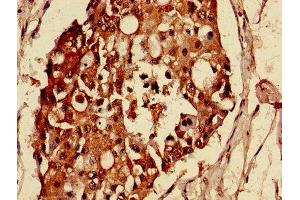 Immunohistochemistry of paraffin-embedded human breast cancer using ABIN7159021 at dilution of 1:100 (MAS1L anticorps  (AA 318-378))