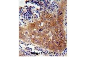 FBXW8 Antibody (Center) (ABIN654676 and ABIN2844371) immunohistochemistry analysis in formalin fixed and paraffin embedded human lung carcinoma followed by peroxidase conjugation of the secondary antibody and DAB staining. (FBXW8 anticorps  (AA 270-299))