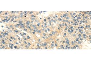 Immunohistochemistry of paraffin-embedded Human breast cancer tissue using CD70 Polyclonal Antibody at dilution 1:40 (CD70 anticorps)