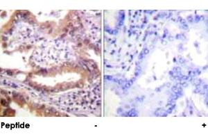 Immunohistochemical analysis of paraffin-embedded human lung carcinoma tissue using IRF3 polyclonal antibody . (IRF3 anticorps)