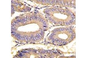 IHC analysis of FFPE human colon carcinoma tissue stained with PAK1 antibody
