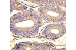 IHC analysis of FFPE human colon carcinoma tissue stained with PAK1 antibody (PAK1 anticorps  (AA 401-430))