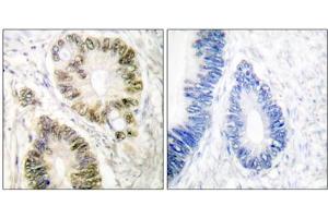 Immunohistochemical analysis of paraffin-embedded human colon carcinoma tissue using Cyclin E1 (phospho-Thr395) antibody. (Cyclin E1 anticorps  (pThr395))