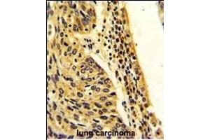 Formalin-fixed and paraffin-embedded human lung carcinoma with FPGS Antibody (Center), which was peroxidase-conjugated to the secondary antibody, followed by DAB staining.