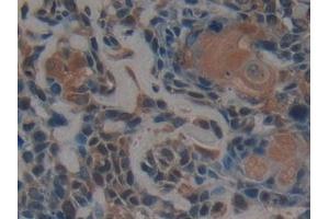 Detection of PSMD9 in Human Lung cancer Tissue using Polyclonal Antibody to Proteasome 26S Subunit, Non ATPase 9 (PSMD9)