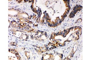 Anti-XIAP antibody, IHC(P) IHC(P): Human Intestinal Cancer Tissue (XIAP anticorps  (N-Term))