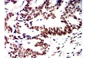 Immunohistochemical analysis of paraffin-embedded rectal cancer tissues using PMS2 mouse mAb with DAB staining. (PMS2 anticorps)