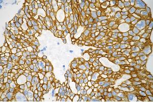 Immunohistochemistry was performed on paraffin-embedded human breast carcinoma using keratin 8 antibody (ABIN7799190), 1:200). (Recombinant KRT8 anticorps)