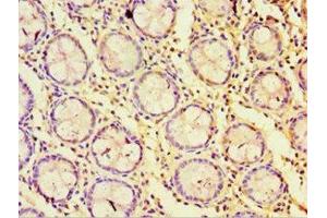 Immunohistochemistry of paraffin-embedded human colon cancer using ABIN7170823 at dilution of 1:100 (Striatin anticorps  (AA 581-780))