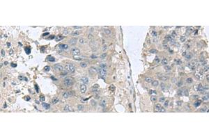 Immunohistochemistry of paraffin-embedded Human liver cancer tissue using NPHP1 Polyclonal Antibody at dilution of 1:60(x200)