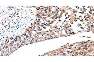 Immunohistochemistry of paraffin-embedded Human esophagus cancer tissue using Connexin-26 Polyclonal Antibody at dilution 1:100 (GJB2 anticorps)