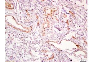 Formalin-fixed and paraffin embedded human lung carcinoma labeled with Anti-PDGF-D Polyclonal Antibody, Unconjugated (ABIN714581) at 1:200 followed by conjugation to the secondary antibody and DAB staining (PDGFD anticorps  (AA 271-370))