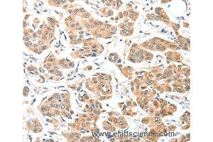 Immunohistochemistry of Human thyroid cancer using ADCK1 Polyclonal Antibody at dilution of 1:40