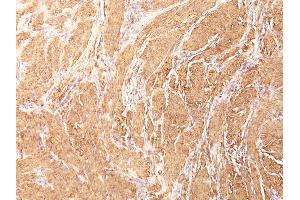 Formalin-fixed, paraffin-embedded human Leiomyosarcoma stained with Muscle Specific Actin Mouse Monoclonal Antibody (HHF35). (ACTA1/ACTA2A/ACTG2 anticorps)