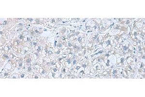 Immunohistochemistry of paraffin-embedded Human liver cancer tissue using ATP6V1C1 Polyclonal Antibody at dilution of 1:100(x200) (ATP6V1C1 anticorps)