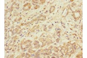 Immunohistochemistry of paraffin-embedded human pancreatic cancer using ABIN7173550 at dilution of 1:100
