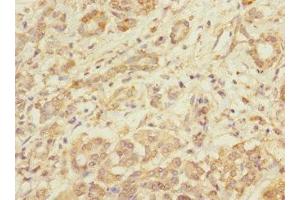 Immunohistochemistry of paraffin-embedded human pancreatic cancer using ABIN7173550 at dilution of 1:100 (Tropomodulin 1 anticorps  (AA 1-359))