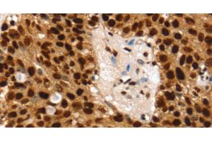 Immunohistochemistry of paraffin-embedded Human breast cancer using SSB Polyclonal Antibody at dilution of 1:30