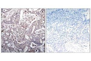 Immunohistochemical analysis of paraffin-embedded human breast carcinoma tissue, using IκB-β (Ab-23) antibody (E021304). (NFKBIB anticorps)