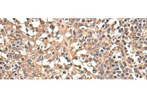 Immunohistochemistry of paraffin-embedded Human tonsil tissue using ATRIP Polyclonal Antibody at dilution of 1:40(x200) (ATRIP anticorps)