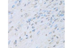 Immunohistochemistry of paraffin-embedded Human liver cancer using KAT2A Polyclonal Antibody at dilution of 1:100 (40x lens).