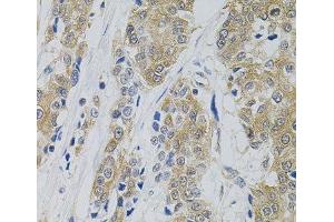 Immunohistochemistry of paraffin-embedded Human prostate cancer using DNM2 Polyclonal Antibody (DNM2 anticorps)