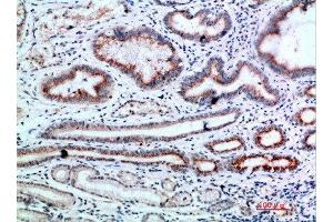 Immunohistochemical analysis of paraffin-embedded human-stomach-cancer, antibody was diluted at 1:200