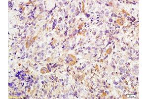 Formalin-fixed and paraffin embedded human osteosarcoma tissue labeled with Anti-Twist Polyclonal Antibody , Unconjugated at 1:200 followed by conjugation to the secondary antibody, (SP-0023), and DAB staining (TWIST1, TWIST2 (AA 71-170) anticorps)