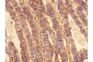 Immunohistochemistry analysis of human colon cancer using ABIN7175296 at dilution of 1:100