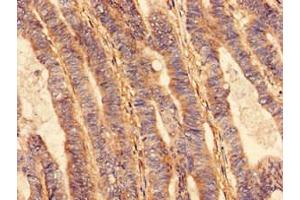 Immunohistochemistry analysis of human colon cancer using ABIN7175296 at dilution of 1:100 (VPS26B anticorps  (AA 1-336))