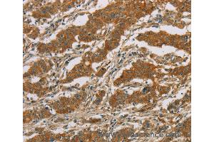 Immunohistochemistry of Human gastic cancer using CYP39A1 Polyclonal Antibody at dilution of 1:50 (CYP39A1 anticorps)