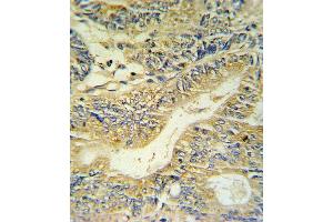 PYY Antibody IHC analysis in formalin fixed and paraffin embedded colon carcinoma followed by peroxidase conjugation of the secondary antibody and DAB staining. (Peptide YY anticorps  (C-Term))