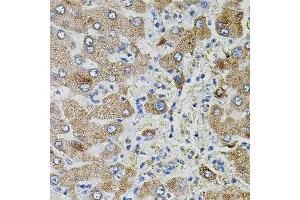Immunohistochemistry of paraffin-embedded human liver injury using TGFA antibody. (Pro-TGF-alpha anticorps)