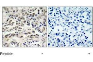 Immunohistochemical analysis of paraffin-embedded human lung carcinoma tissue using CDKN1B polyclonal antibody  . (CDKN1B anticorps  (Ser10))
