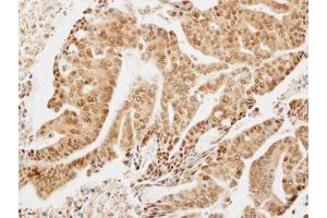 IHC-P Image Immunohistochemical analysis of paraffin-embedded OVCA xenograft, using LIMD1, antibody at 1:300 dilution. (LIMD1 anticorps  (C-Term))