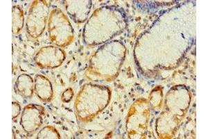 Immunohistochemistry of paraffin-embedded human gastric cancer using ABIN7142369 at dilution of 1:100 (MRPL2 anticorps  (AA 61-305))