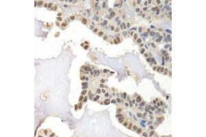 Immunohistochemistry of paraffin-embedded human thyroid cancer using GTF2F1 antibody (ABIN5971324) at dilution of 1/200 (40x lens). (GTF2F1 anticorps)