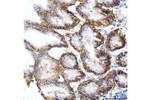 IHC analysis of Carbonic Anhydrase 9/CA9 using anti-Carbonic Anhydrase 9/CA9 antibody (ABIN7600076). (CA9 anticorps  (AA 146-414))
