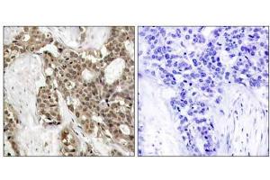 Immunohistochemical analysis of paraffin-embedded human breast carcinoma tissue, using p44/42 MAP Kinase (phospho-Tyr204) antibody (E011246). (ERK1/2 anticorps  (pTyr204))