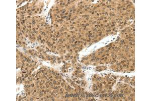 Immunohistochemistry of Human liver cancer using TERF2 Polyclonal Antibody at dilution of 1:30 (TRF2 anticorps)